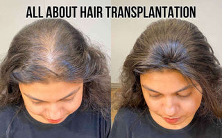 Hair Transplantation - Yay or Nay?